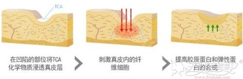 韩国Dot Peeling去疤药