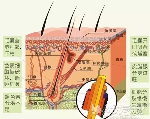 韩国无削发非切开式植发手术无痕改善脱发问题