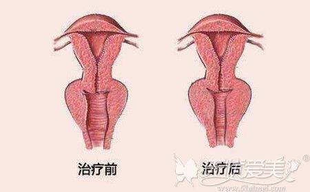 阴道紧缩术治疗前后对比图
