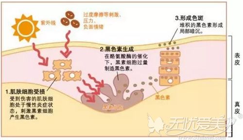 皮肤暗沉出现色斑？果酸焕肤、光子嫩肤和调Q激光都能祛除