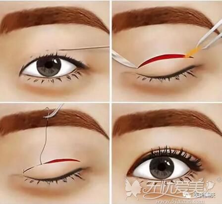 用可吸收的线做全切双眼皮缝合安全吗?顺便开眼角会留疤吗?