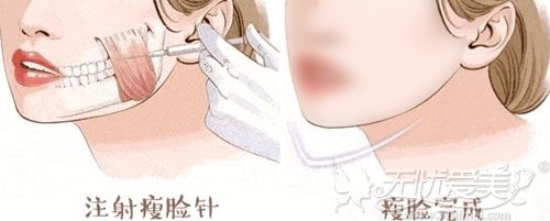 韩国“无创瘦肌肉术”一次就能轻松摆脱肥大的咬肌