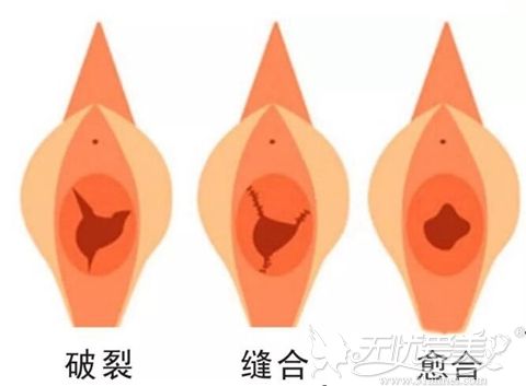 处女膜修复术