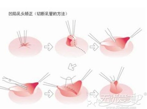 乳头内陷切断矫正法