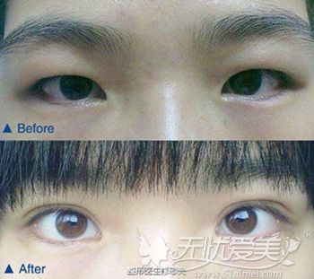 肿眼泡经过双眼皮手术后效果对比