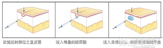 玻尿酸填充鼻唇沟原理