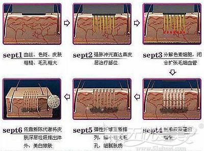 光子嫩肤祛斑原理解析