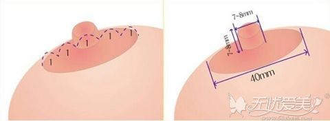 乳晕缩小手术方法有哪些?术后会留疤痕吗?