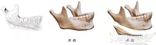 面部磨骨效果不理想能做修复吗？修复术后多久能恢复？