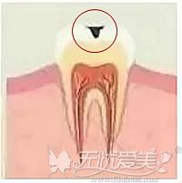 龋齿还分浅龋、中龋和深龋 往后发展还会得牙髓炎
