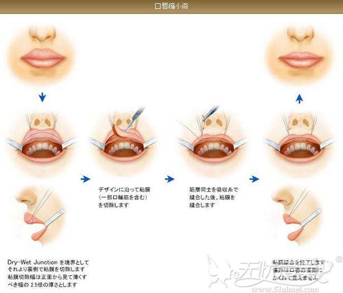缩唇手术的原理