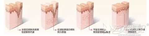 果酸焕肤祛痘痘和痘坑
