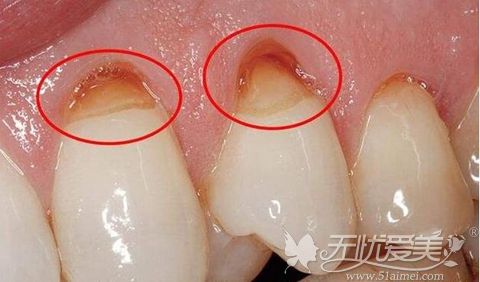 牙周疾病导致牙缝大