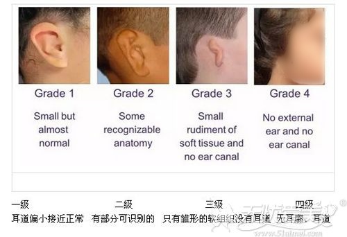 小耳畸形整形多少钱？耳修复材料不同费用也不同