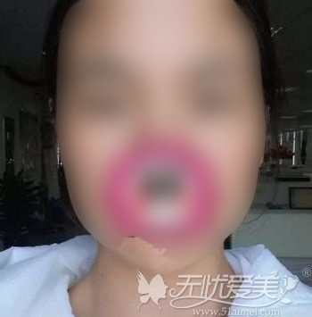 找北京百达丽做双眼皮修复手术后1个月眼睛就变美了