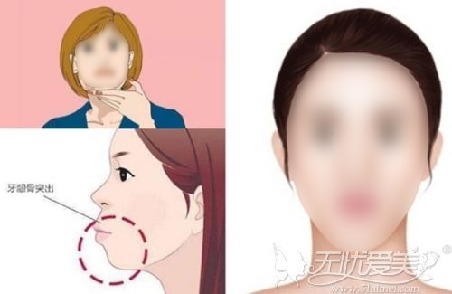 韩国“三颚轮廓术”改善突嘴、无下巴的同时还能矫正牙齿