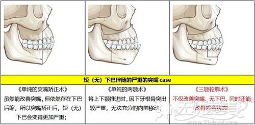韩国三颚轮廓术手术对比