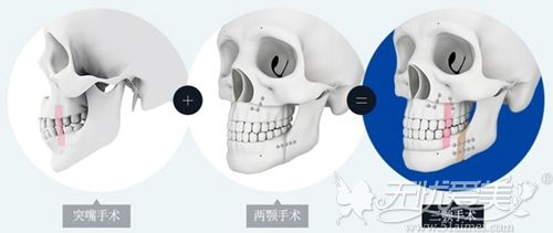 韩国三颚轮廓术手术原理
