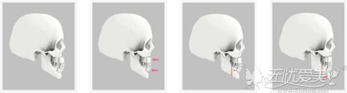 韩国三颚轮廓术手术过程