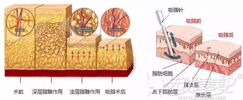 腰腹吸脂的原理