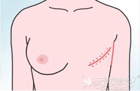 乳房再造术