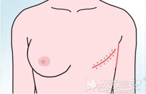 乳房再造用哪种手术方法好？需要多少钱？