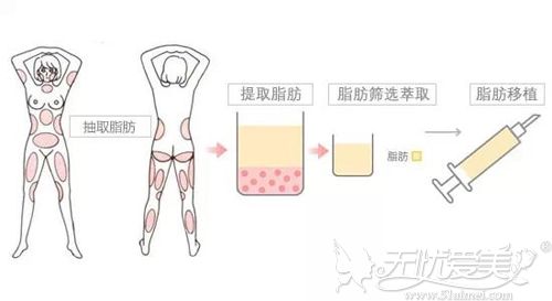 广州5家自体脂肪填充移植整形医院&医生攻略整理笔记