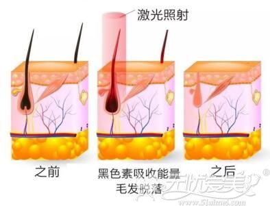 激光脱毛的原理