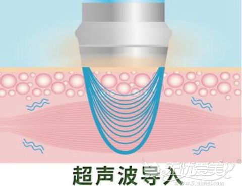 超声波去眼袋