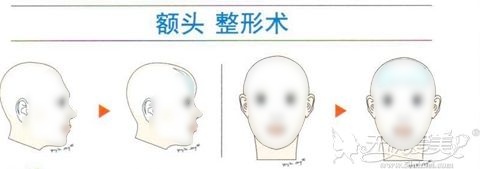 骨水泥填充额头