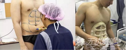 腹部蚀刻手术原理 腹部蚀刻手术原理