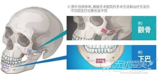 面部轮廓整形需要使用钛钉