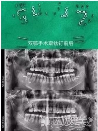双鄂手术后取出钛钉