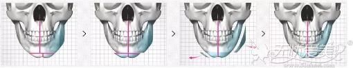 脸部大小不对称下颌角手术矫正过程