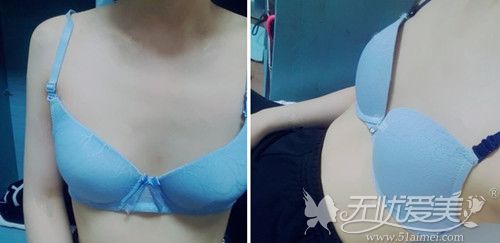 分享我在韩国玛博尔做蓓菈假体丰胸手术半年的恢复全过程