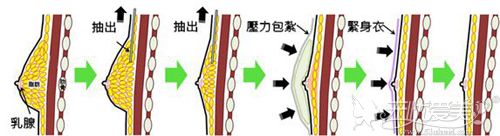 脂肪型肥大术过程原理