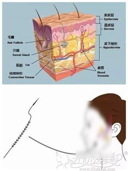 青春支架面部提升除皱术的原理