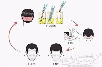 种植发际线的手术原理