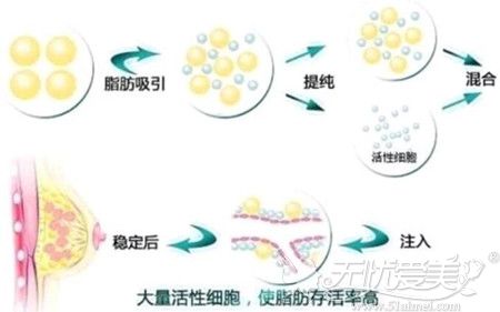 自体脂肪移植提取过程