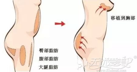 自体脂肪移植隆胸手术