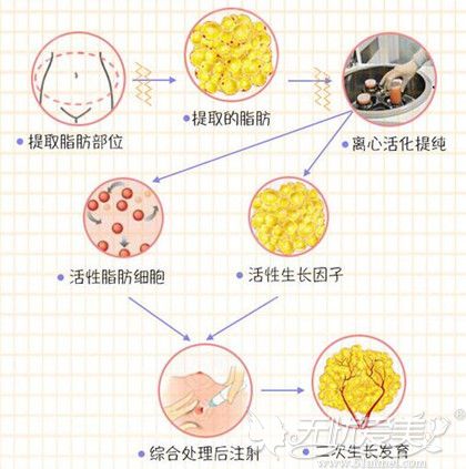 自体脂肪移植隆胸手术提取过程