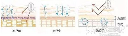 染料激光去除红血丝的原理