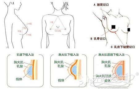 假体丰胸的手术方法