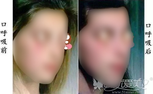 口呼吸造成凸嘴