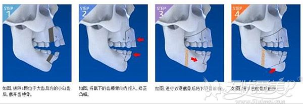 上鄂前部截骨改善凸嘴