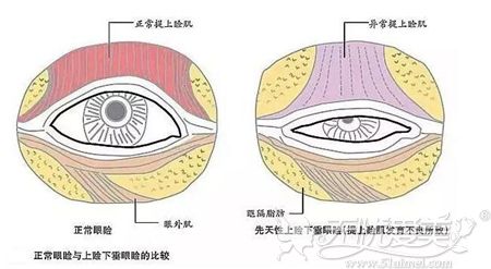 提肌矫正