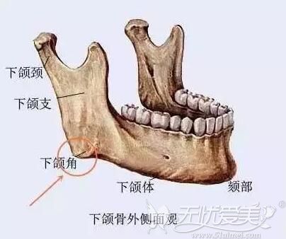 下颌骨角部骨性肥