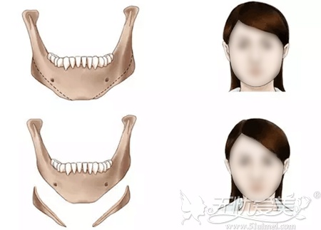 下颌角切除手术前后