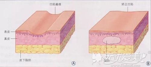 凹陷性疤痕形成原因