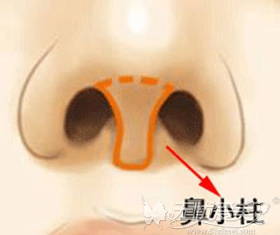 鼻小柱问题导致隆鼻手术失败